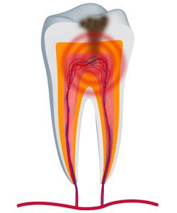 root canals with a Derry NH dentist near Londonderry