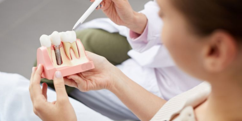 Dental Implants in US-Vanguard Dental Group