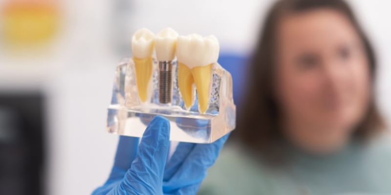 Dental Implant in Derry NH-Vanguard Dental Group