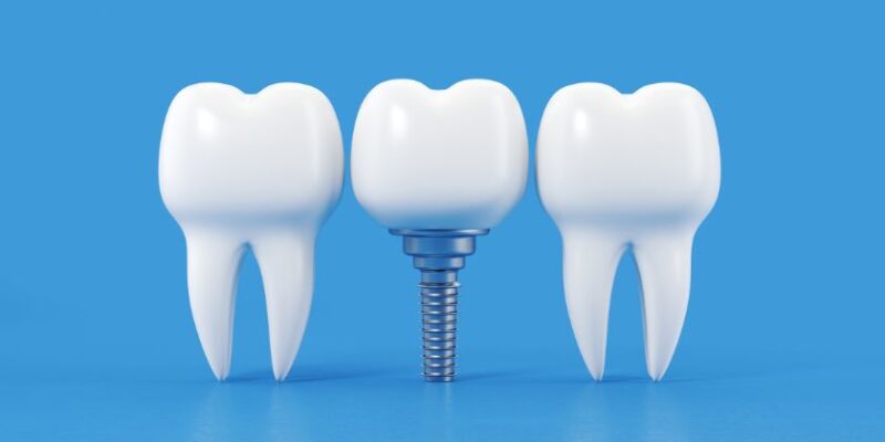 Dental Implants - Vanguard Dental Group